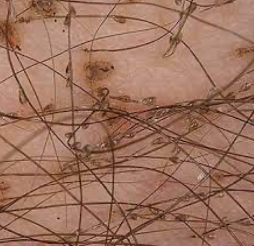 phthirus pubis_2.png