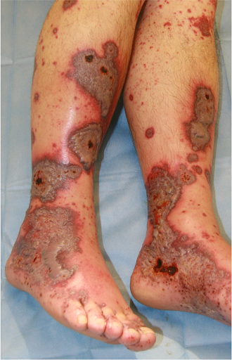 Füsse mit Blutblasen