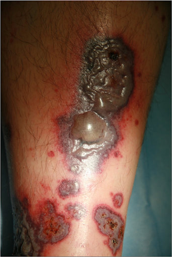 Blutblasen Nahansicht