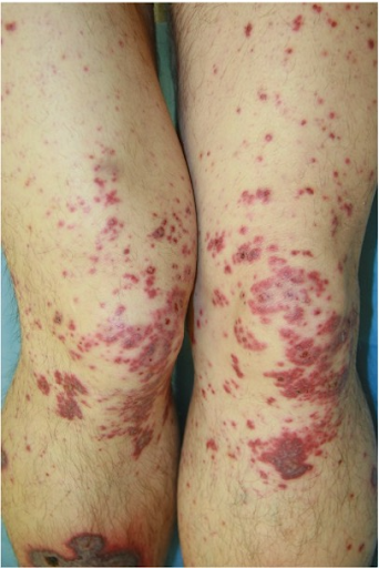 Vereinzelte Blutblasen an Bein