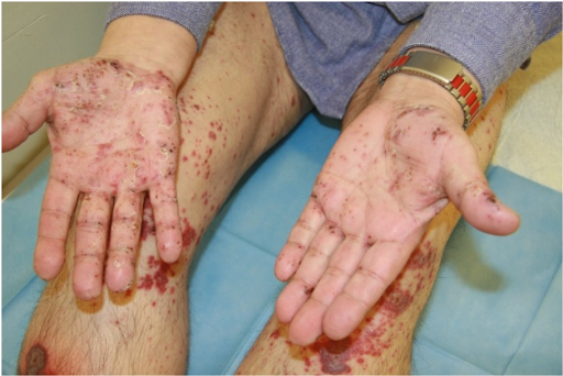 Blutblasen an Händen